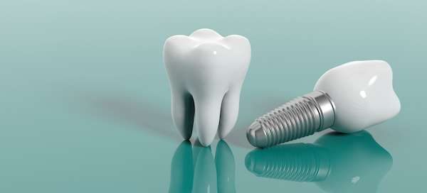 dental-implants-in-turkije