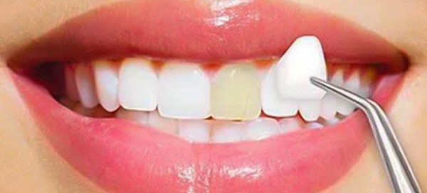 dental-veneers-in-turkey