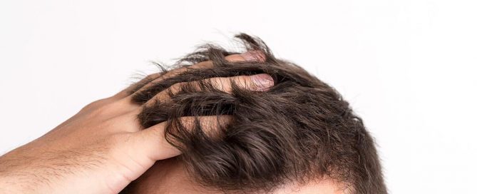 haartransplantation-in-der-turkei