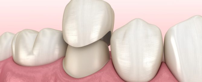 dental-crown-in-turkey